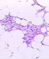 脂肪瘤切除術 脂肪瘤切除術