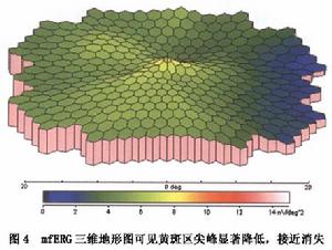 增生性玻璃體視網膜病變