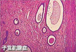 子宮腺肌瘤 子宮腺肌瘤