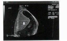 速度向量成像技術 速度向量成像技術