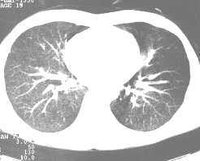 血行播散型肺結核