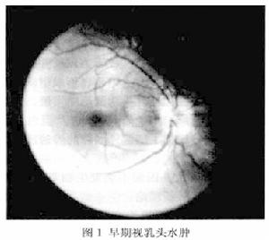 視神經乳頭水腫及視盤水腫