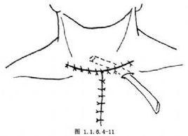 胸骨後巨大甲狀腺腫瘤切除術 胸骨後巨大甲狀腺腫瘤切除術