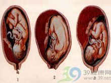胎盤早剝