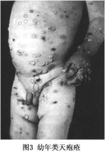 幼年型皰疹樣皮炎
