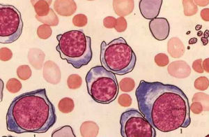 遺傳性球形紅細胞增多症
