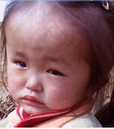 梗阻性腦積水 梗阻性腦積水