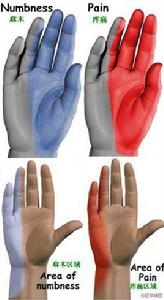 核上性麻痹綜合徵 核上性麻痹綜合徵