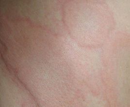 兒童蕁麻疹 兒童蕁麻疹