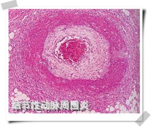 結節性動脈周圍炎 結節性動脈周圍炎