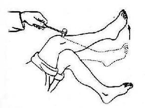 巴賓斯基征陽性 巴賓斯基征陽性