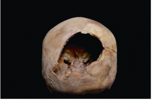 　做過顱骨環鑽手術的頭骨