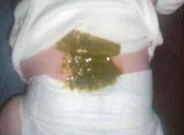 深黃色或帶綠色的水樣便 深黃色或帶綠色的水樣便