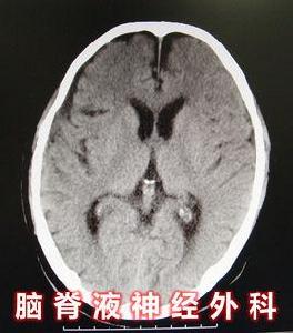 良性高顱壓 良性高顱壓