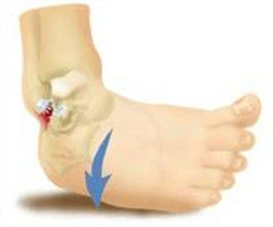 關節韌帶扭傷 關節韌帶扭傷