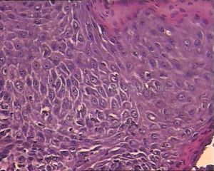 病毒濕疣 病毒濕疣