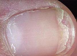 指甲易碎 指甲易碎