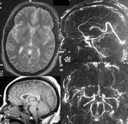 顱內高壓症 顱內高壓症