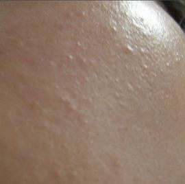 閉合粉刺 閉合粉刺