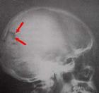 血管性偏頭痛 血管性偏頭痛