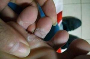 腳濕氣病 腳濕氣病