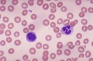 放射性甲狀腺炎