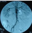肺動靜脈瘤 肺動靜脈瘤