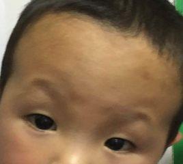 兒童斜視手術 兒童斜視手術