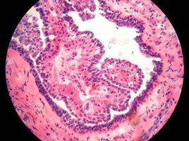 導管內乳頭狀瘤 導管內乳頭狀瘤