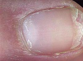 指甲突然變白 指甲突然變白