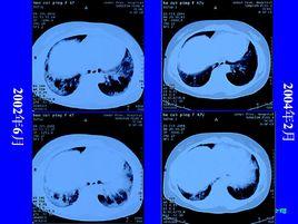 特發性間質性肺炎 特發性間質性肺炎