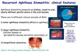 復發性阿弗他性口腔炎 復發性阿弗他性口腔炎