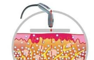 電波拉皮除皺術 電波拉皮除皺術