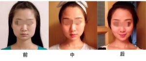 治療前後效果對比圖