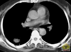 鸚鵡熱衣原體肺炎