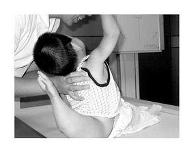 脊柱裂脊髓脊膜膨出 脊柱裂脊髓脊膜膨出