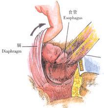示意圖4:游離食管和賁門、分離膈肌腳