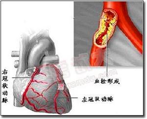 老年人急性心肌梗死