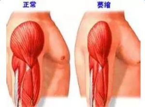 慢性炎性脫髓鞘性多發性神經病