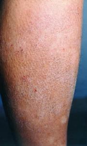 系統性澱粉樣變性