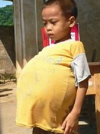 先天性巨結腸 先天性巨結腸