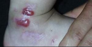 遺傳性大皰性表皮鬆解症