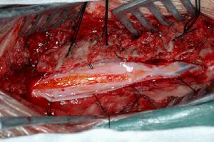 小兒椎管內腫瘤