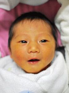 感染性黃疸 感染性黃疸