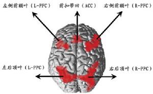 胼胝體進行性變性