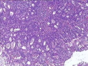 直腸腺癌 直腸腺癌