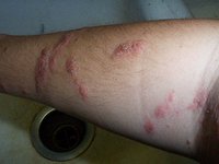 毒漆藤引起的腿部硬皮疹