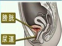 老年女性膀胱頸梗阻 老年女性膀胱頸梗阻