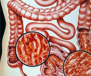 壞死性小腸結腸炎 壞死性小腸結腸炎