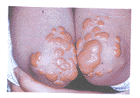 家族性高膽固醇血症 引起的症狀